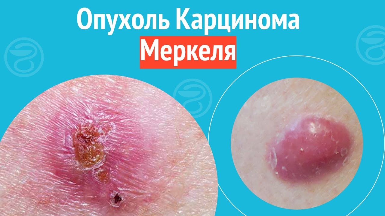 👉 Опухоль Карцинома Меркеля