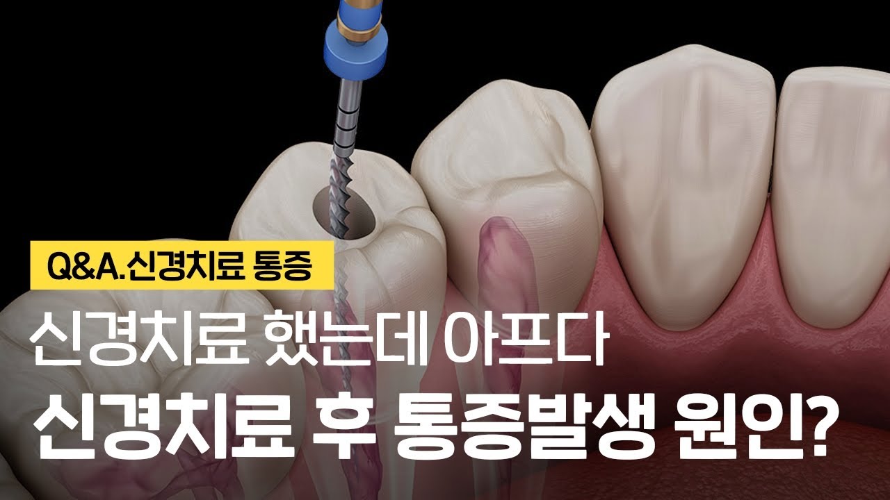 신경치료 후 통증 발생 원인 왜 생길까?(마취, 약, 기간, 첫날 등)