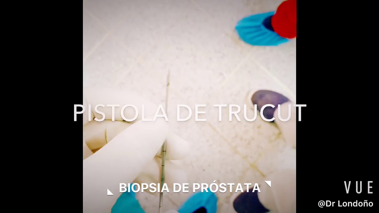 biopsia de próstata transperineal cuánto tiempo duran