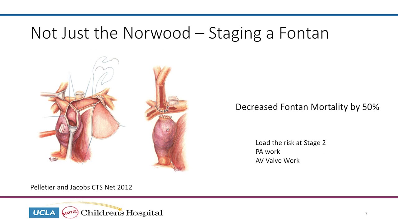 The Fontan Operation: What We Have Learned - Glen Van Arsdell, MD | 2019 NFFS Symposium