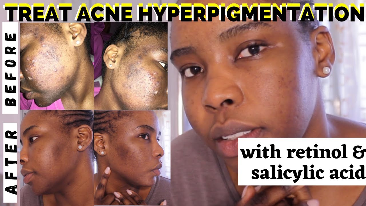 Treat Hyperpigmentation Dark Spots Using Retinol And Salicylic Acid