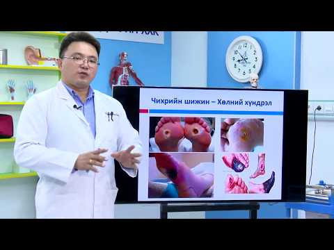 Видео: Чихрийн шижингийн кетоацидозыг эмчлэх 3 арга