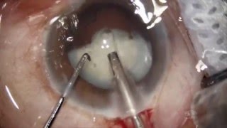 White Cataract Phaco emulsification 4k Dr Deepak Megur