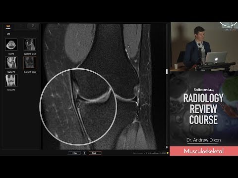 Horizontal Meniscal Tears (MRI) - Radiology Review Course