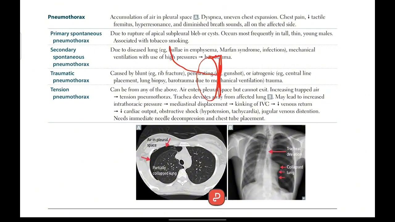 Pneumothorax Respiratory 23 First Aid USMLE in Urdu/Hindi YouTube