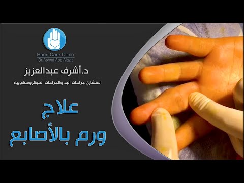 علاج ورم بالأصابع دكتور أشرف عبد العزيز استشاري جراحة اليد