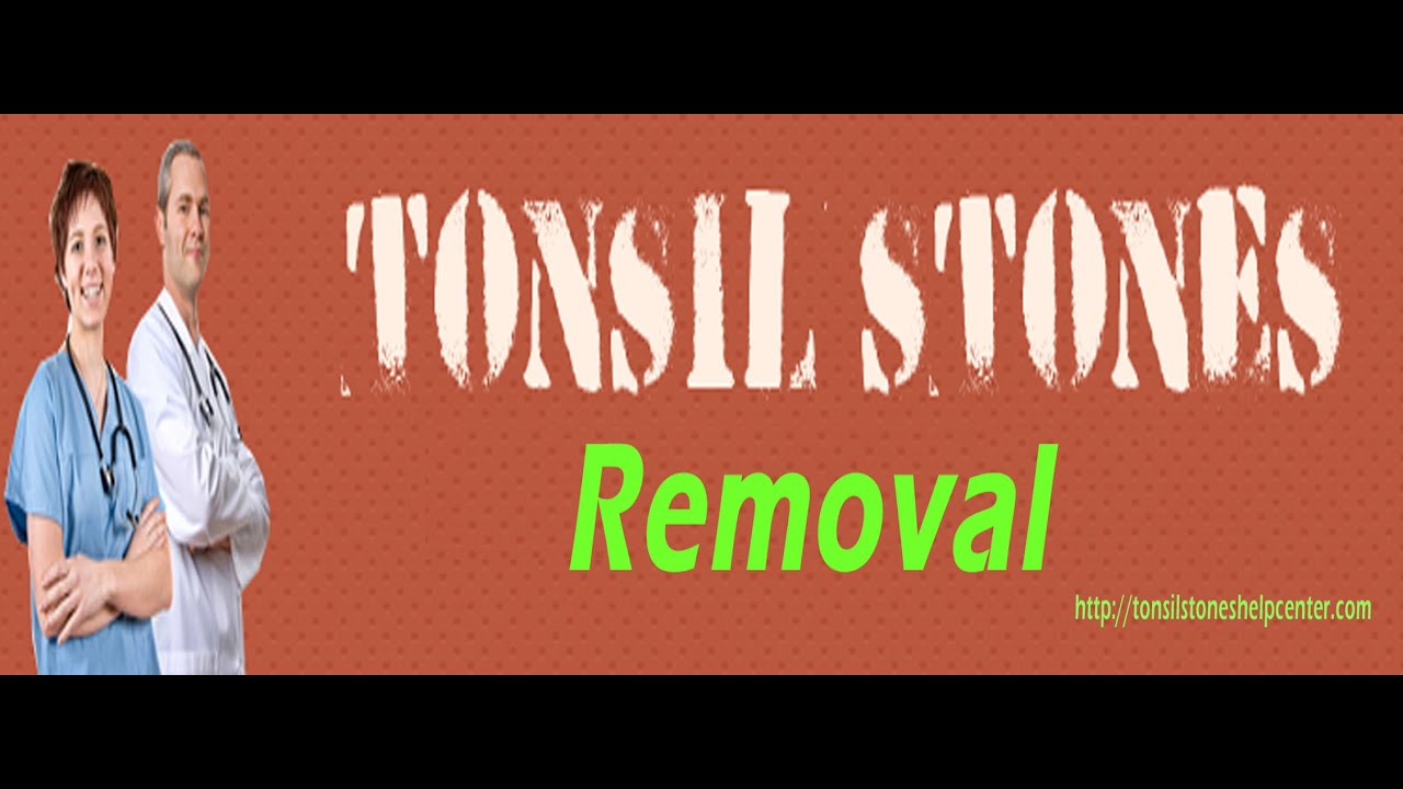 Natural Tonsil Stone Removal Within Just 4 Weeks YouTube