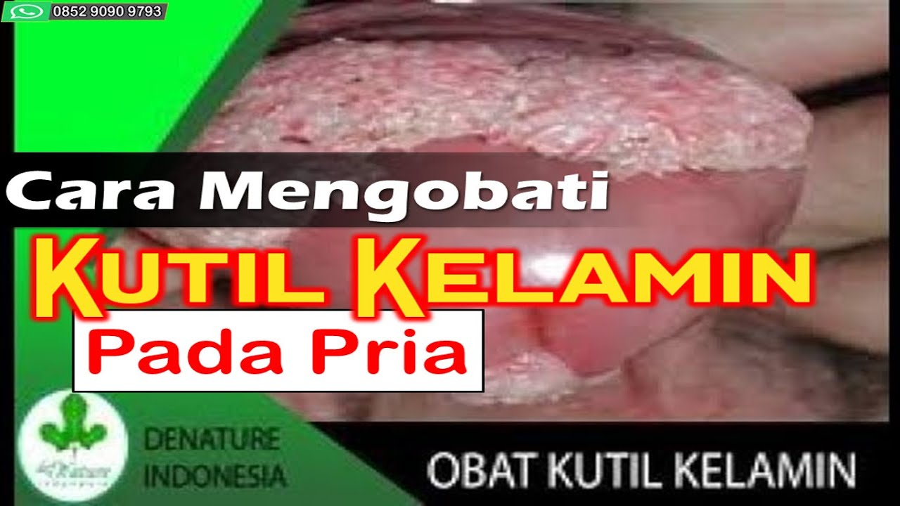 Cara Mengobati Nyeri Pada Alat Kelamin Pria Cara Mengobati Kutil Kelamin Pada Pria - YouTube