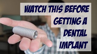 Important things you should know about dental implants - Dental implant facts