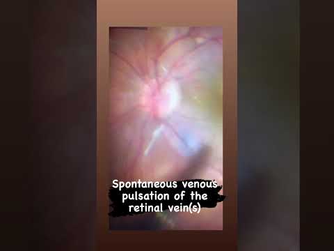 نبض وريد الشبكية المركزي في عين الانسان