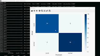 Deep Learning Transfer with AlexNet for Chest X Ray COVID 19 Recognition