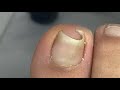 Curved nail treatment