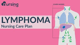 Nursing Care Plan for Lymphoma (Nursing Care Plan Tutorial)