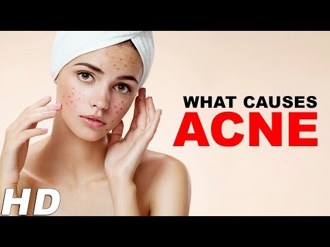 Real Causes Of Pimples Or Acne On Face | Know The Reasons Behind Acne Problems - Healthy Women