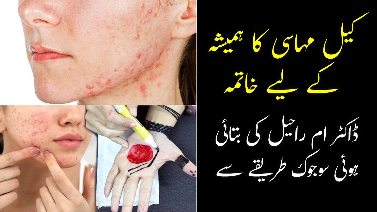Keel Muhase Ka Gharelu Ilaj Acne Treatment At Home Sujok Therapy