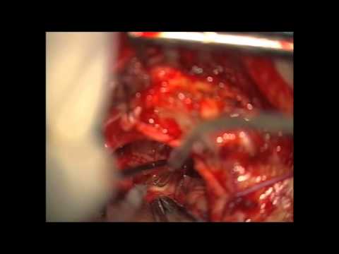 Vestibular  Schwannoma Resection