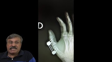 TPTS (Tangari Prakash Trauma System) in hand injuries