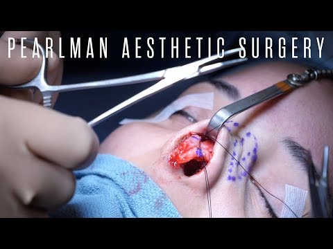 Rhinoplasty NYC সার্জারি Pt.1 - ডাঃ স্টিভেন পার্লম্যান