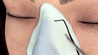 Septo-Rhinoplasty 3D Protocol - Piezotome M+