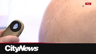 Alberta doctor warns of summertime skin cancer risks