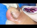 Ep_6090 Foot nails skin removal 👣 ทำยังไงดี..ไม่มีตัวช่วย 😊 (clip from Thailand)