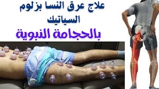 علاج السياتيك بوزلوم عرق النسا بالحجامة النبوية والزيوت الطبيعية