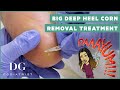 Big deep satisfying heel corn removal treatment on the foot | DG Podiatrist