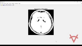 MRI SEGMENTATION OF THE HUMAN BRAIN USING MULTI RESOLUTION EDGE DETECTION AND REGION GROWING