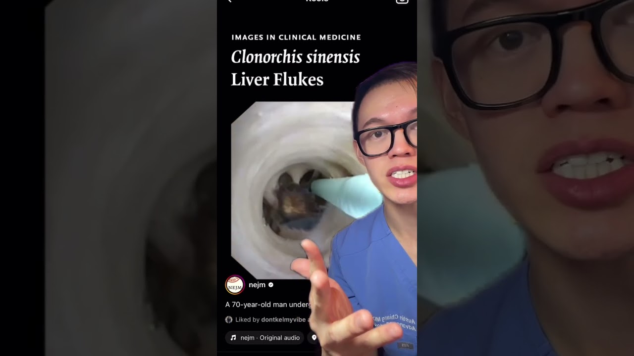 🍣 Liver critters #liverfluke #liver #parasite