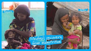 Medina's Recovery From Severe Malnutrition In Ethiopia | Unicef
