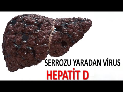 Qaraciyəri serroz edən - Hepatit D