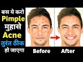मुंहासे कैसे हटाए | How to get rid of pimples overnight | How to remove pimples, Acne treatment