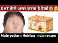 How does DHT destroy our scalp hair and cause Hairloss कैसे होता हे 🤔 बाल गायब??