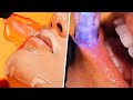 How to get SOFTER and PLUMPER LIPS | Microneedling Facial