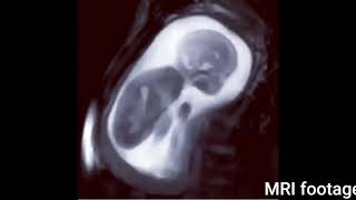 MRI FOOTAGE OF AN 8 MONTH OLD BABY