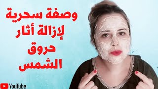 وصفة سحرية لإزالة أثار حروق الشمس