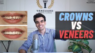 CROWNS VS VENEERS: WHICH ONE SHOULD YOU GO FOR?