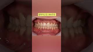 #치아교정비용. 서울대교정과전문의에게 치료받는 과개교합교정과 덧니교정 (02 886 2877 신도림역 가이치과) #치아교정비용 #덧니교정 #과개교합교정 #치아교정 #덧니교정비용