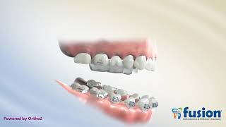 Anterior Crossbite RPE Correction
