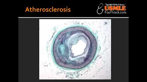 Atherosclerosis - Risk Factors, Progression, Complications, Location & Symptoms
