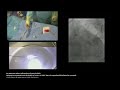 How to Modify Calcific Plaque