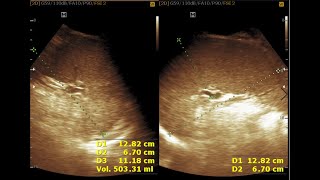 Ultrasound cases 271 of 2000 || Four Cases Of Splenomegaly