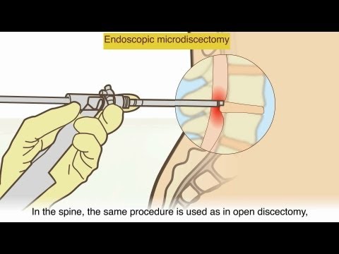 Video: Hernia-discchirurgie: Wat Te Verwachten