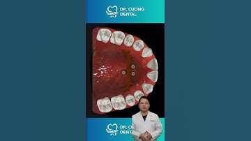 Răng thưa thì phải làm sao | Bác sĩ Cường