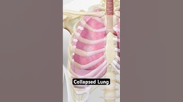 Uitleg over een ingestorte long (3D-animatie)