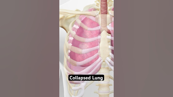 Collapsed lung explained (3D Animation)