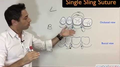 How to perform a sling suture?