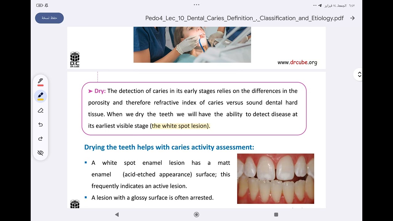 pediatric lec 7+8 dental caries classification and etiology+ rampant caries + early childhood caries