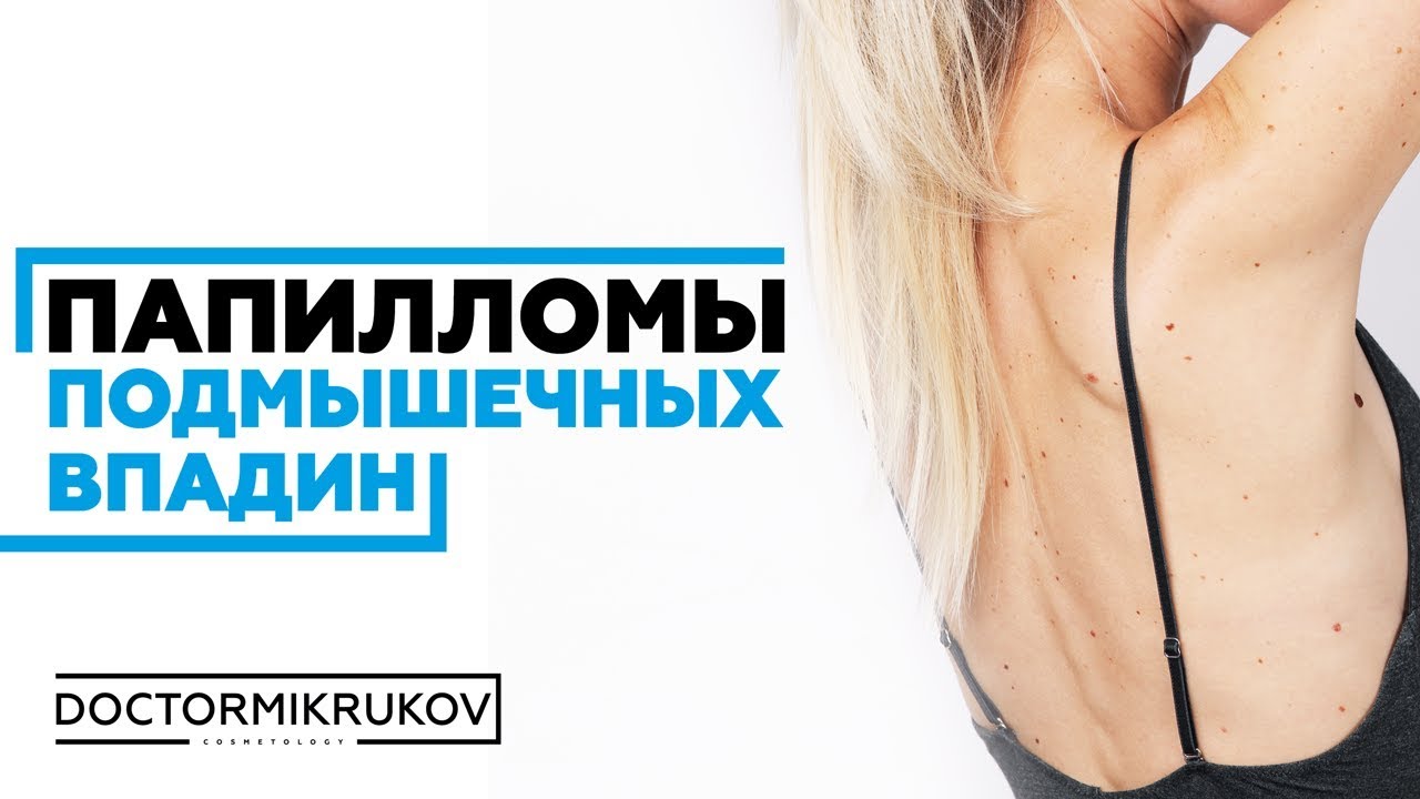 Папилломы подмышечных впадин #удалениепапиллом #удалитьпапилломуростов ...