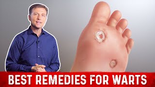 4 Best Wart Removal Remedies – Dr. Berg on Wart Treatment at Home screenshot 3